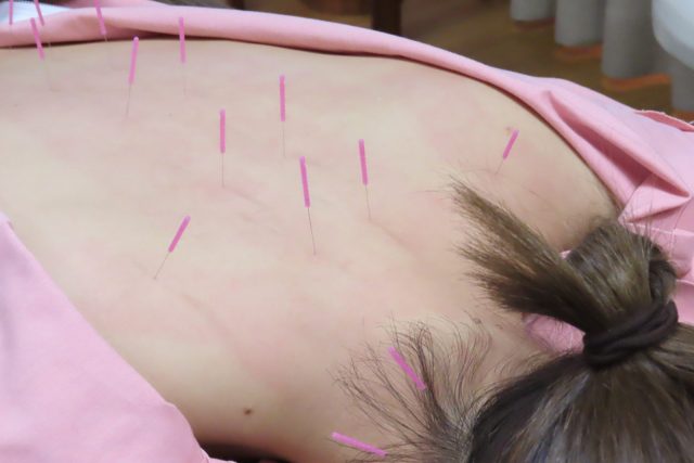 Person lying on their stomach during acupuncture treatment, with numerous pink needles inserted along the back.