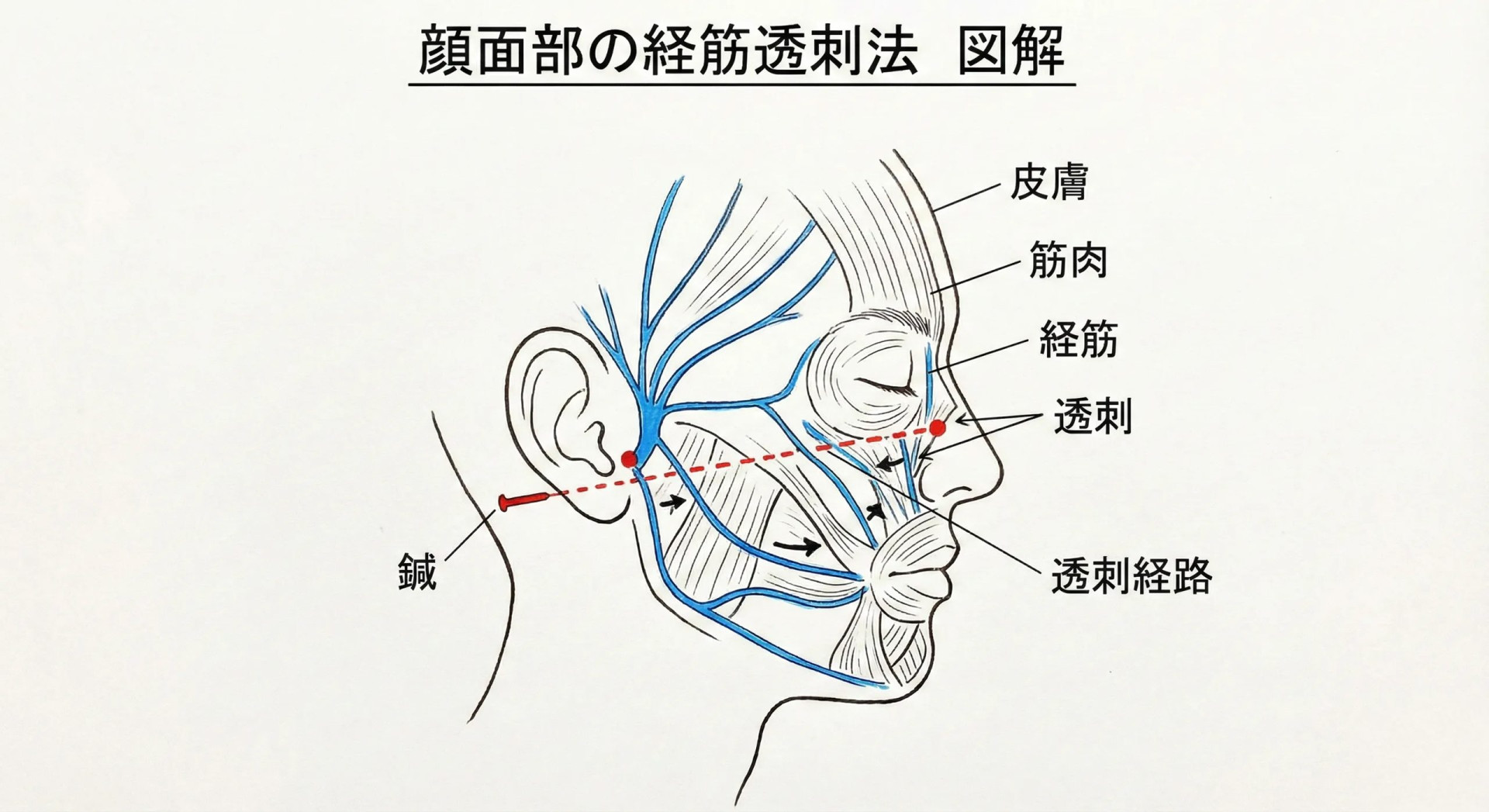 顔面神経麻痺への経筋透刺法